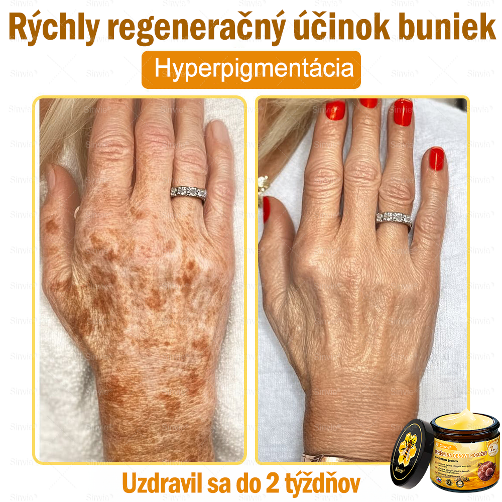 🐝 Sinvie® včelím jedom obnovu pokožky Krém (👨⚕CE schválené)👍✅