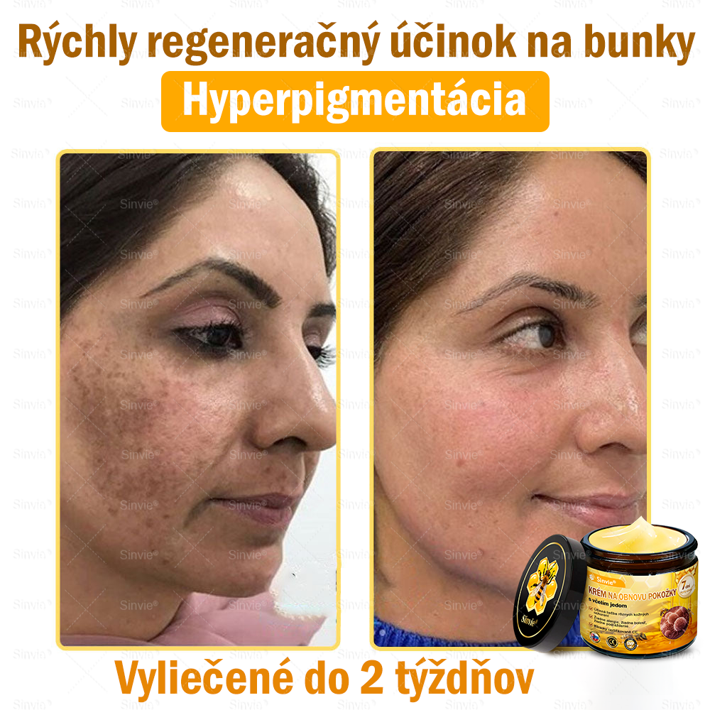 🐝 Sinvie® včelím jedom obnovu pokožky Krém (👨⚕CE schválené)👍✅