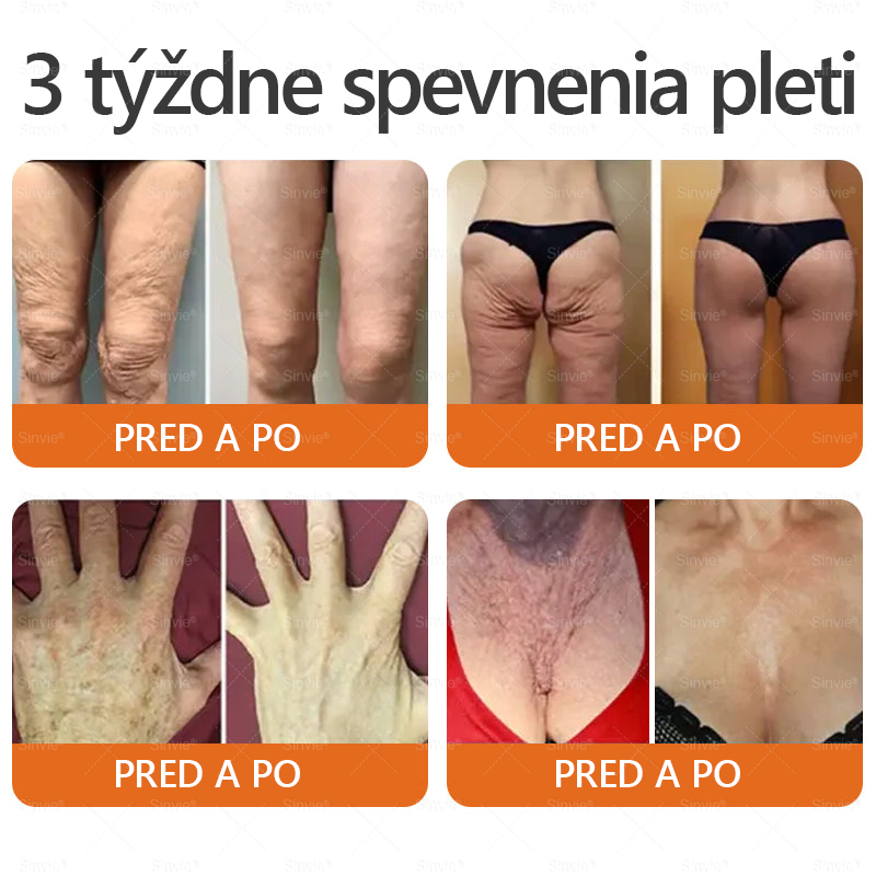 🐝 Sinvie® včelím jedom obnovu pokožky Krém (👨‍⚕‍CE schválené)👍✅